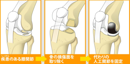 人工関節部分置き換え術