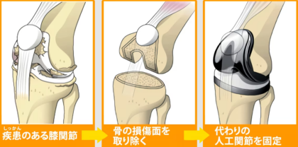 人工関節置き換え術