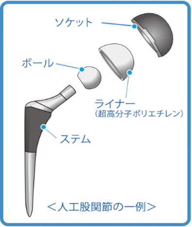 人工股関節置換術